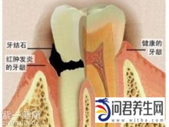 哪些疾病容易导致牙结石发生?